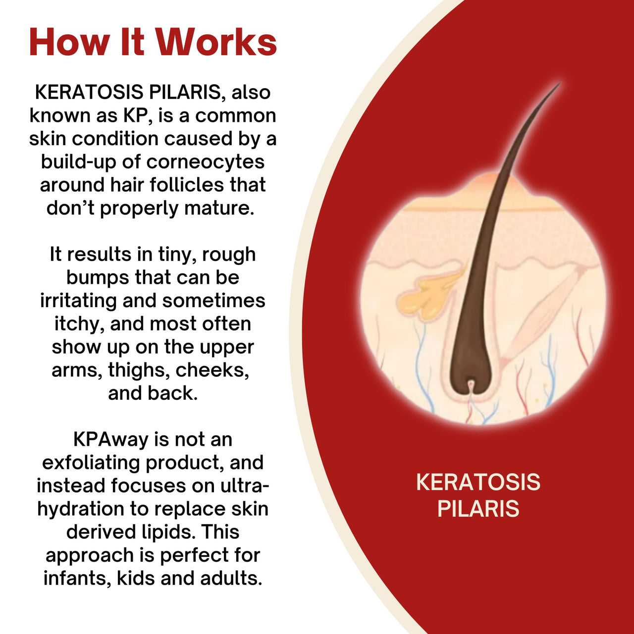 KPAWAY Moisturizing Keratosis Pilaris Cream for Kids | Gentle Hydration for Dry, Bumpy Skin | Dermatologist-Developed Lotion | Non-Irritating, Acid-Free Formula | 16 oz