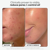 Thumbnail for Paulas Choice--SKIN PERFECTING 2% BHA Liquid Salicylic Acid Exfoliant--Facial Exfoliant for Blackheads, Enlarged Pores, Wrinkles & Fine Lines, 4 oz Bottle