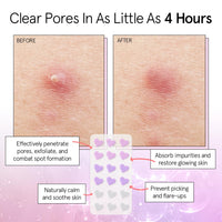Thumbnail for grace & stella Award Winning Pore Strip - Pimple Patches for Face - Heart Hydrocolloid Zit Stickers that Help Soothe & Conceal Breakouts - Cute Patches - Dermatologist-Tested, Vegan (Heart, 72 Count)