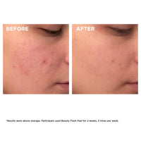 Thumbnail for Clarins Beauty Flash Peel | 10-Minute At-Home Facial | Visibly Tightens Pores | Gently Eliminates Dead Skin Cells | Refines Skin Texture | Renews Radiance | Contains AHAs and BHAs | All Skin Types