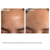 Thumbnail for Clarins Beauty Flash Peel | 10-Minute At-Home Facial | Visibly Tightens Pores | Gently Eliminates Dead Skin Cells | Refines Skin Texture | Renews Radiance | Contains AHAs and BHAs | All Skin Types