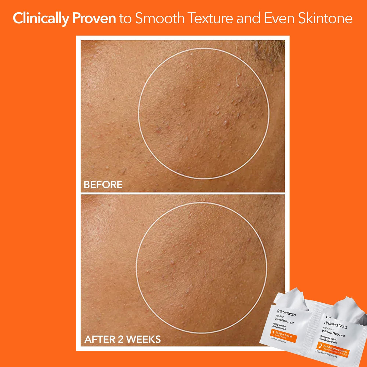 Dr Dennis Gross Alpha Beta Universal Daily Peel: for Uneven Tone or Texture and Fine Lines or Enlarged Pores, (5 Treatments)