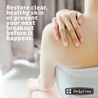 Thumbnail for De La Cruz Sulfur Ointment - Cystic Acne Treatment for Face and Body - Daily 10 Min Spot Treatment Mask - Safe and Effective Game Changing Hormonal Acne Treatment That Clears Up Pimples - 2.6 OZ