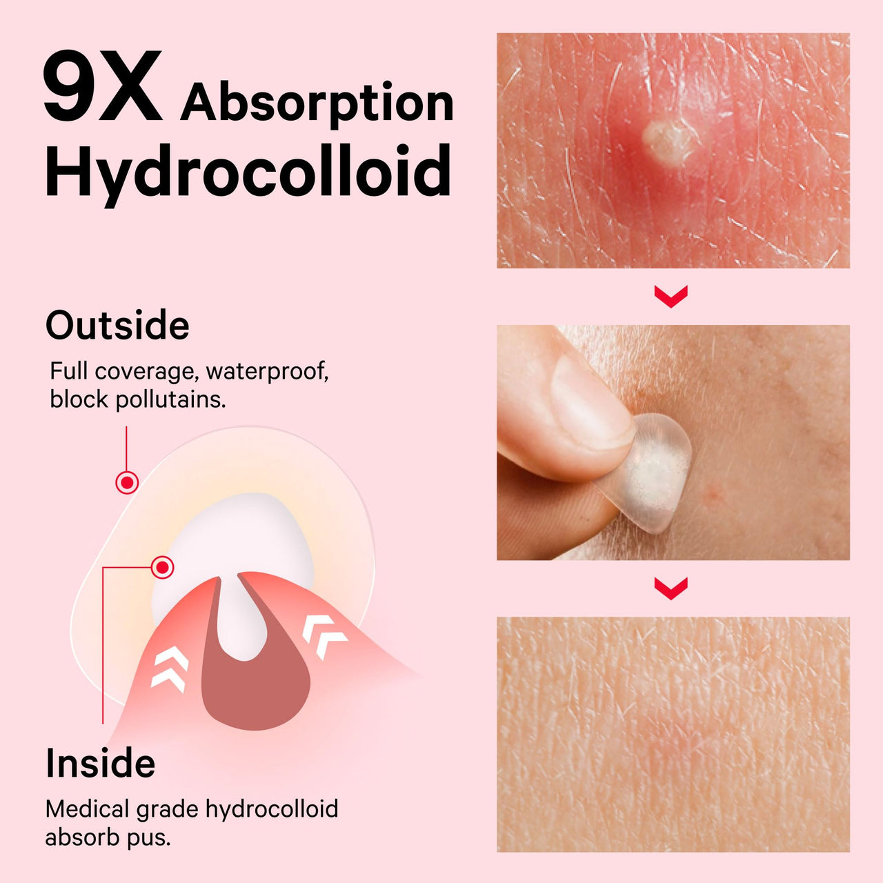 Sosky Pimple Patches for Face, Invisible Hydrocolloid Acne Patches, HSA Store Eligible Items, Zit Sticker for Face and Skin, Pimple Sticker for Covering Zits, Blemishes with Salicylic Acid 48 Count