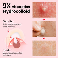 Thumbnail for Sosky Pimple Patches for Face, Invisible Hydrocolloid Acne Patches, HSA Store Eligible Items, Zit Sticker for Face and Skin, Pimple Sticker for Covering Zits, Blemishes with Salicylic Acid 48 Count