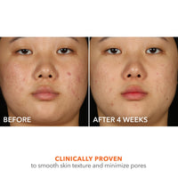 Thumbnail for Dr Dennis Gross Alpha Beta® 2% BHA+ Breakout Solution, Minimizes Pores, Clear & Prevent Breakouts, 5 Fl Oz
