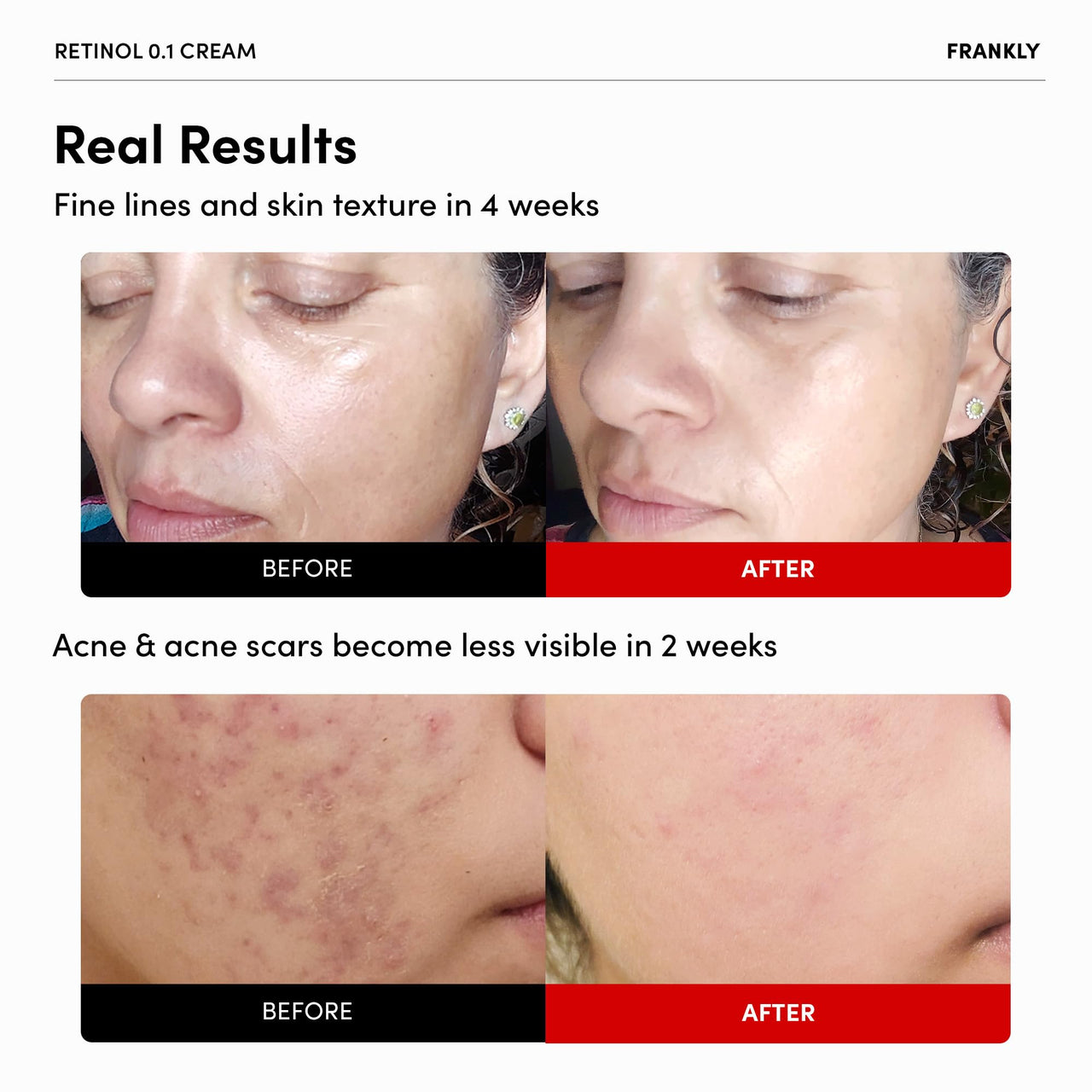 FRANKLY Retinol 0.3% Cream, 0.7 fl oz - Intensive Retinol | Night Cream | Retinol, Ceramides & Natural Ginseng | Anti-aging, Wrinkles Care, Reduces Congestion and hyperpigmentation | Korean Skin Care