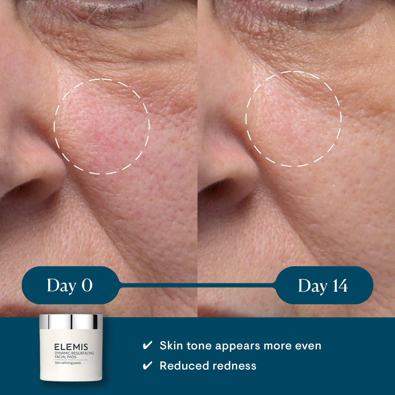 ELEMIS Dynamic Resurfacing Facial Pads - Blackhead Refining Treatment - Gentle Daily Skin Resurfacer - Lactic Acid, Tri-Enzyme - 60-Count Jar
