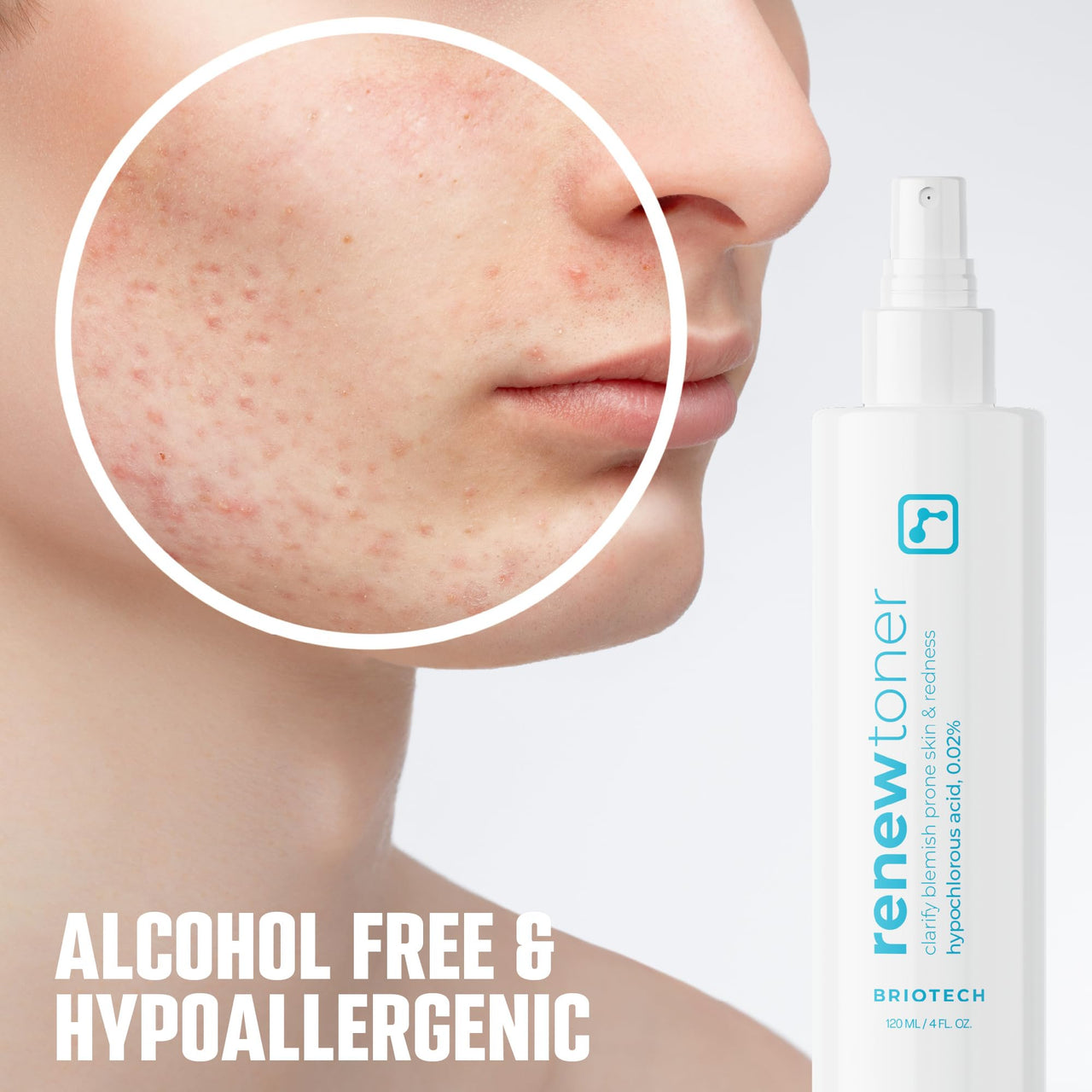 BRIOTECH Skin Renew Toner, Hypochlorous Acid Spray Topical Skin Spray for Face and Skin, Minimize Appearance of Blemishes, Soothing Mist for Redness & Bumps, 4 fl oz