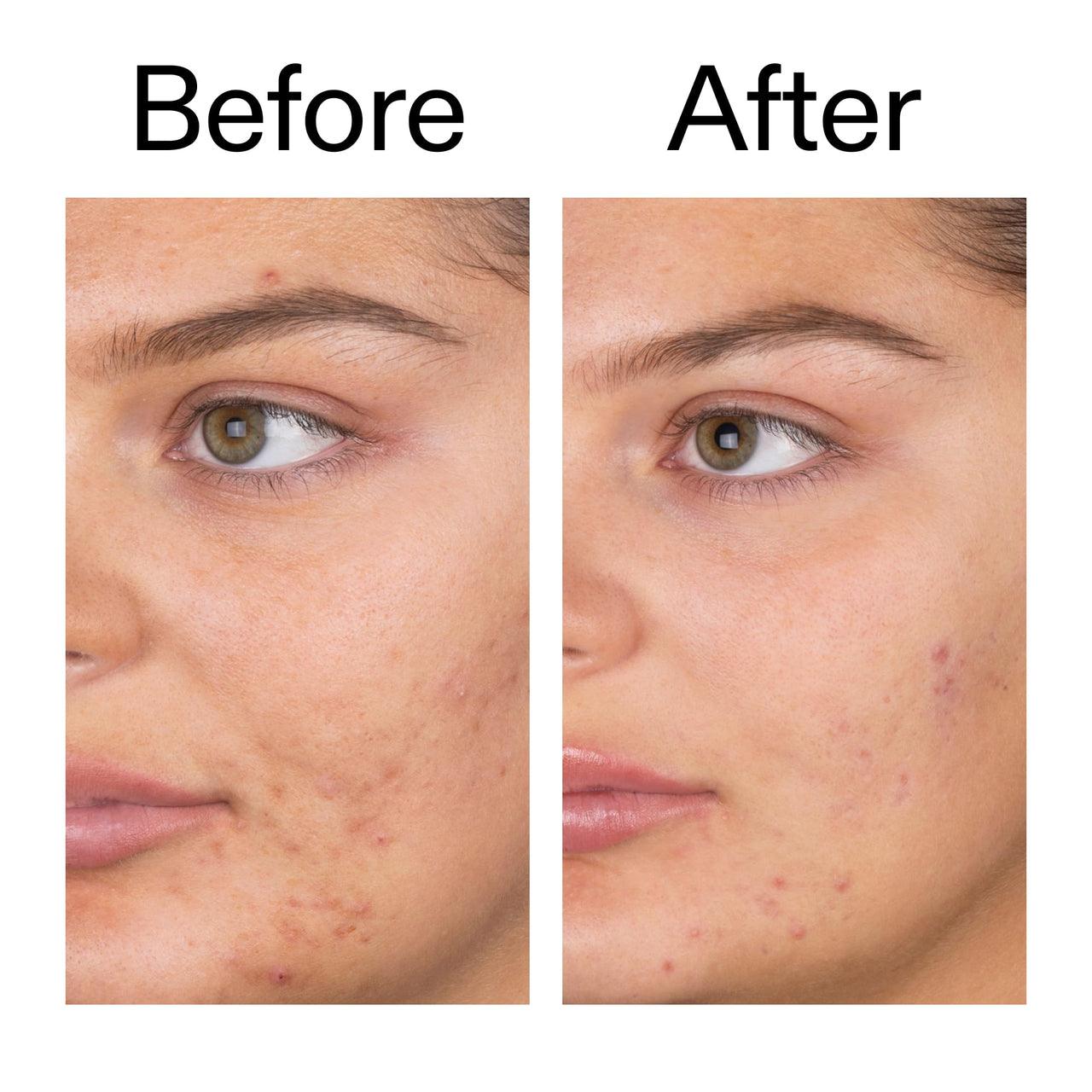 The INKEY List Salicylic Acid Cleanser - Daily Exfoliating Cleanser with 2% Salicylic Acid & Zinc PCA, Unclogs Pores, Anti Acne, Reduces Blackheads & Excess Oil for Clearer Skin
