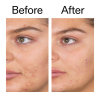 Thumbnail for The INKEY List Salicylic Acid Cleanser - Daily Exfoliating Cleanser with 2% Salicylic Acid & Zinc PCA, Unclogs Pores, Anti Acne, Reduces Blackheads & Excess Oil for Clearer Skin