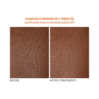 Thumbnail for Dr Dennis Gross Alpha Beta Exfoliating Body Treatment | Multi-Tasking Powered by AHA/BHAs for Smooth, Hydrated Skin While Improving Ingrown Hairs, Keratosis Pilaris, and Blemishes | 8 Textured Towels