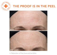 Thumbnail for Dr. Dennis Gross Alpha Beta Ultra Gentle Daily Peel: for Dehydrated or Sensitive Skin, Uneven Tone or Texture, Fine Lines or Enlarged Pores (30 Treatments)