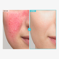 Thumbnail for TOSOWOONG SOS Repair CICA Clinic Zinc Cream, 100,000ppm Zinc Oxide, Heal, Soothe Acne, Redness, Rosacea Treatment, Skin Barrier Repair, Moisture, Non-Comedogenic, Korean Skin care, 50g, 1.76 oz.