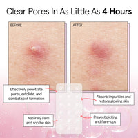 Thumbnail for grace & stella Pimple Patches for Face - Fast Acting Hydrocolloid Acne Patch That Absorb Gunk, Flatten Breakouts - Zit Stickers for Clear Skin - Dermatologist-Tested, Vegan (Invisible, 36 Count)