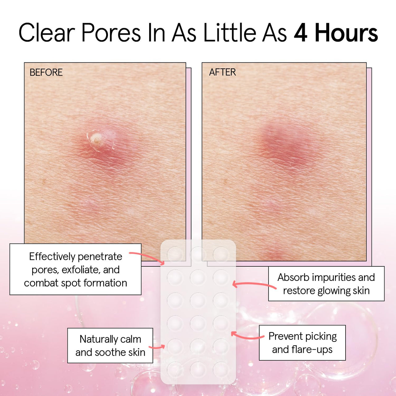 grace & stella Award Winning Pore Strip Pimple Patches for Face - Hydrocolloid Acne Patches for Shrinking Zits, Whiteheads - Spot Stickers - Dermatologist-Tested, Vegan (Invisible, 72 Count)