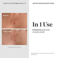 Thumbnail for Murad Acne Retexturizing Face & Body Pads - Smooth + Soothe - with Azelaic + Bacteria-Targeting Multi-Acids to Soothe Irritation, Redness, and Providing Oil-Free Hydration, 45Pc