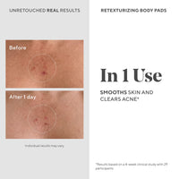 Thumbnail for Murad Retexturizing Body Pads – Acne-Fighting Exfoliating Pads with Azelaic, Salicylic, and Glycolic Acid for Acne Breakouts, Smoothing KP Bumps, and Soothing Aggravated Skin – 45 Pads