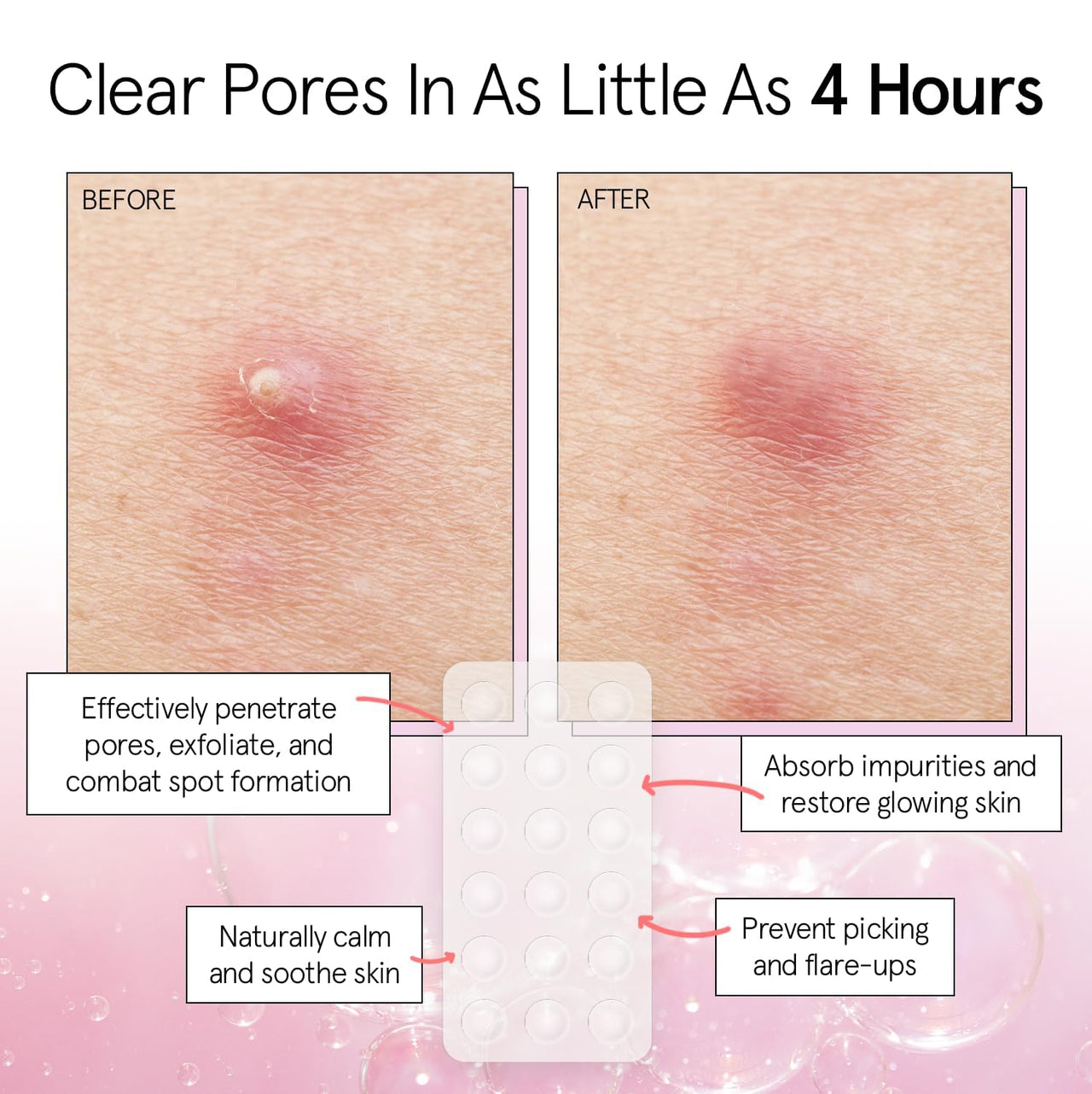 grace & stella Pimple Patches for Face - Fast Acting Hydrocolloid Acne Patch That Absorb Gunk, Flatten Breakouts - Zit Stickers for Clear Skin - Dermatologist-Tested, Vegan (Invisible, 72 Count)