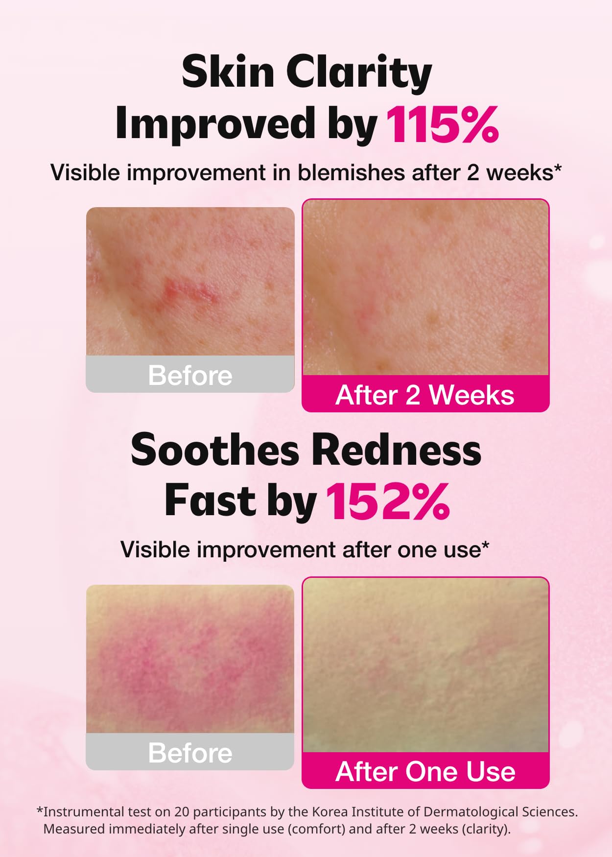 ISOI Blemish Care Up Serum for Face, Vegan Hydrating Serum for Smooth & Glass Skin Effect, Skin Barrier & Moisture Balance for Women, Arbutin & Rose Otto Oil, Korean Skin Care (0.85 fl. oz, 25ml)