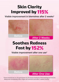 Thumbnail for ISOI Blemish Care Up Serum for Face, Vegan Hydrating Serum for Smooth & Glass Skin Effect, Skin Barrier & Moisture Balance for Women, Arbutin & Rose Otto Oil, Korean Skin Care (0.85 fl. oz, 25ml)