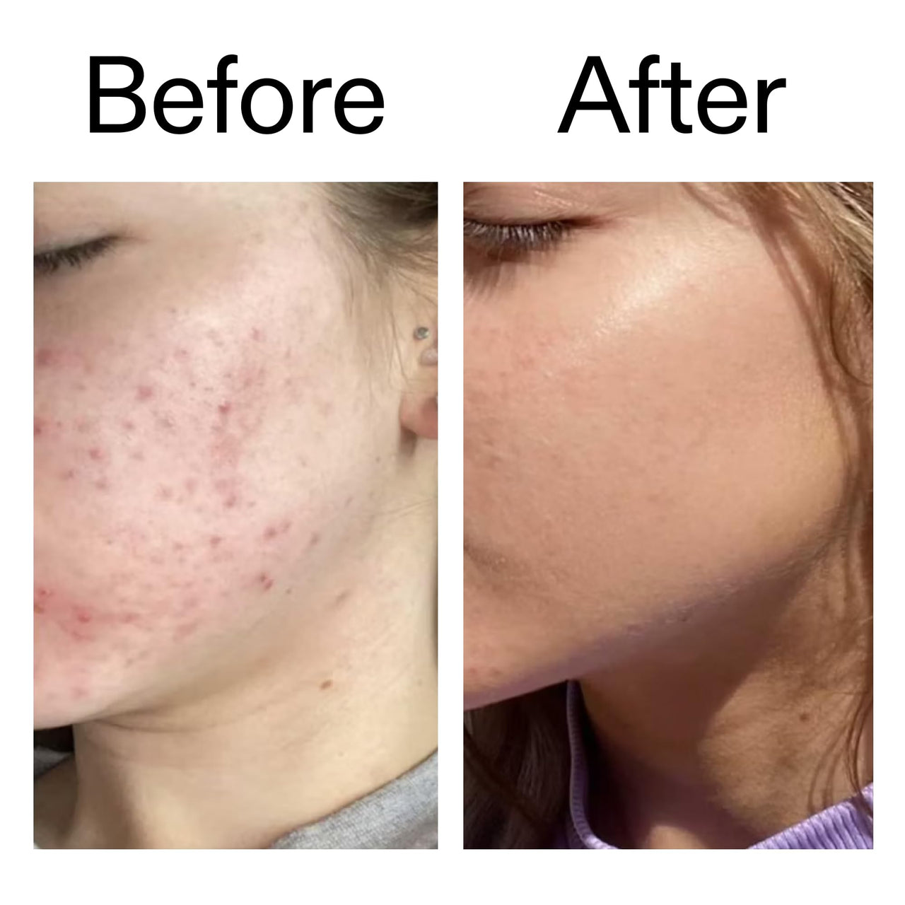 The INKEY List Beta Hydroxy Acid (BHA) Serum, Face Exfoliant for Normal, Oily or Dry Skin, Target Pores and Blackheads, 1.01 fl oz