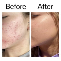 Thumbnail for The INKEY List Beta Hydroxy Acid (BHA) Serum, Face Exfoliant for Normal, Oily or Dry Skin, Target Pores and Blackheads, 1.01 fl oz