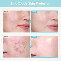 Thumbnail for TOSOWOONG SOS Repair CICA Clinic Zinc Cream, 100,000ppm Zinc Oxide, Heal, Soothe Acne, Redness, Rosacea Treatment, Skin Barrier Repair, Moisture, Non-Comedogenic, Korean Skincare, 50g, 1.76 oz.