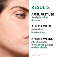Thumbnail for VICHY Normaderm Acne Control Daily Moisturizer, Oil Free Acne Moisturizer For Face, Max Strength 2% Salicylic Acid + Hyaluronic Acid + Vitamin C, Targets Blackheads, Blemishes & Enlarged Pores