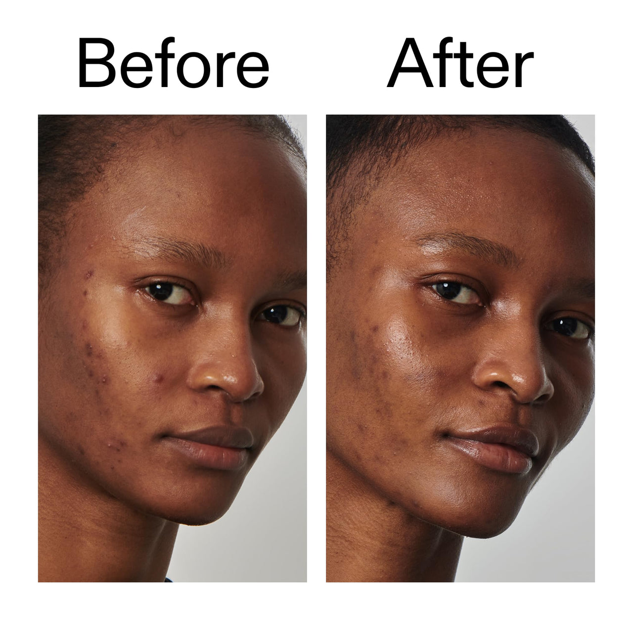 The INKEY List SuperSolutions Niacinamide 20% Serum, Helps with Healthy-Looking Skin Texture, Pores and Balancing Excess Oil, Skin Barrier Protection 1.01 fl oz