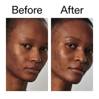Thumbnail for The INKEY List SuperSolutions Niacinamide 20% Serum, Helps with Healthy-Looking Skin Texture, Pores and Balancing Excess Oil, Skin Barrier Protection 1.01 fl oz