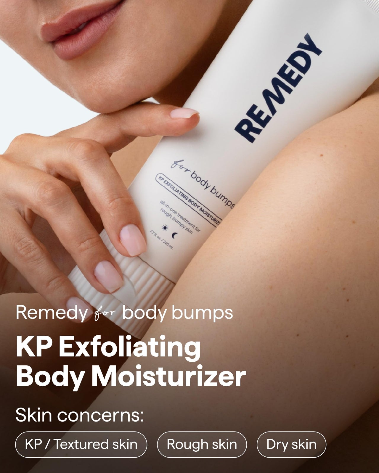 Remedy KP Body Moisturizer | Keratosis Pilaris and Chicken Skin Treatment with Retinol, Urea, Lactic Acid and Ceramides | Exfoliating and Moisturizing Lotion | By Dermatologist Dr. Shah, 7.7 fl oz