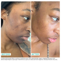 Thumbnail for Urban Skin Rx® Combination Skin 3-In-1 Daily Treatment Cleansing Bar, Exfoliator + Rejuvenating Mask, Hydrates & Helps Diminish the Appearance of Dullness, Dark Marks, Fine Lines & Wrinkles, 2.0 Oz