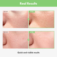 Thumbnail for TOSOWOONG Green Tomato Pore Ampoule with Green Tomato, Witch Hazel and Hyaluronic Acid for Face Moisturizer and Pore Minimizing Treatment, Korean Skincare, 30ml, 1.01 fl. oz.