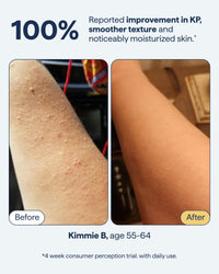 Thumbnail for Remedy KP Body Moisturizer | Keratosis Pilaris and Chicken Skin Treatment with Retinol, Urea, Lactic Acid and Ceramides | Exfoliating and Moisturizing Lotion | By Dermatologist Dr. Shah, 7.7 fl oz