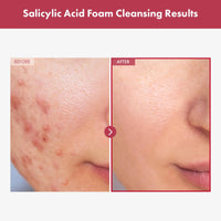 Thumbnail for TOSOWOONG Salicylic Acid Foam Cleanser for Oily Skin, 18,000ppm Salicylic Acid, Deep Pore Cleansing, Face Wash For Breakouts, Exfoliating Cleanser, Korean Skin Care, 100ml, 3.38 fl. oz.