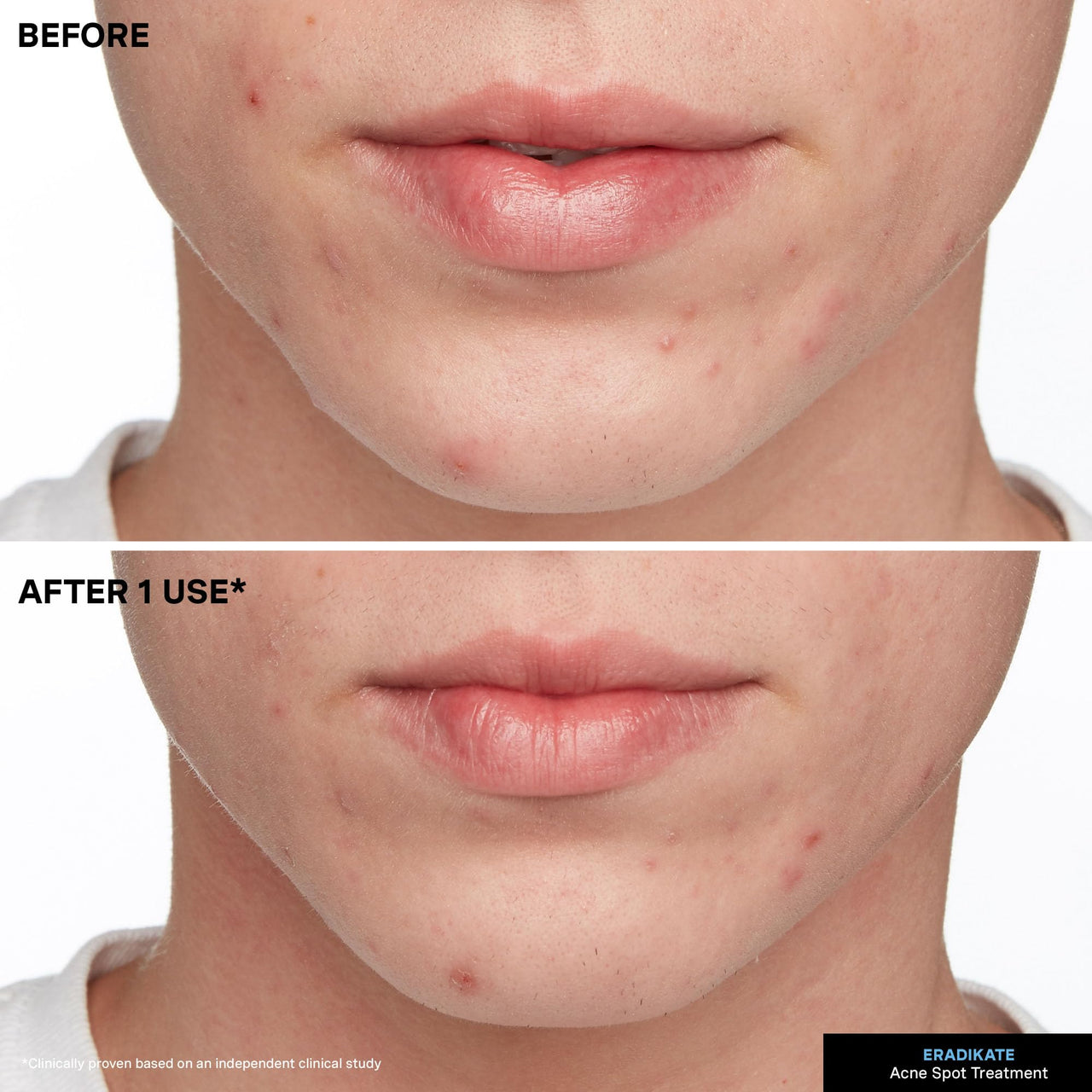 Kate Somerville EradiKate Acne Treatment - Clinically Formulated 10% Sulfur and BHA Spot Treatment – Clears Pimples, Cleans Pores and Prevents Breakouts, 1 Fl Oz