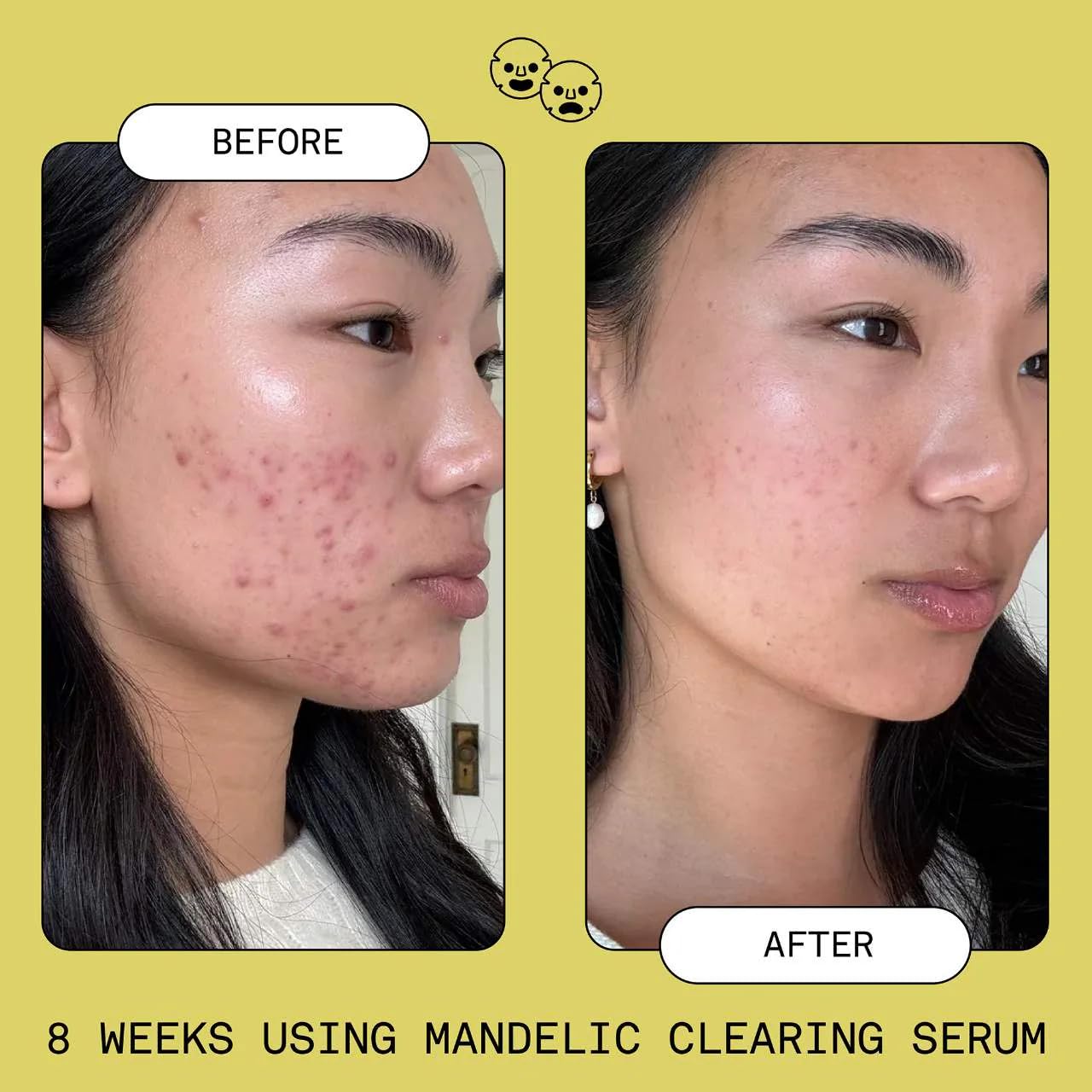 SOFIE PAVITT FACE Mandelic Acid Exfoliating & Clearing Serum 0.95 oz/28 mL
