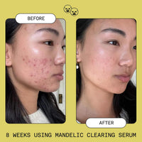 Thumbnail for SOFIE PAVITT FACE Mandelic Acid Exfoliating & Clearing Serum 0.95 oz/28 mL