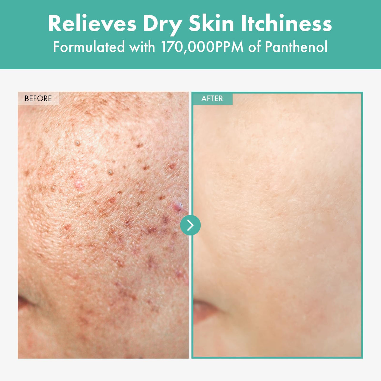 TOSOWOONG Dexpanthenol Cream, 170,000ppm B5 Panthenol, Madecassoside, Centella Asiatica for Skin Barrier Repair, Facial Moisturizer, Soothing, Hydrating, Korean Skincare, 60ml, 2.02 fl. oz.