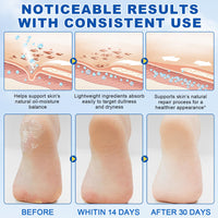 Thumbnail for Urea Cream Stick 60% Plus 2% Salicylic Acid, Extra Strength Urea Foot Cream for Dry Cracked Heels, Callus Remover for Feet,Moisturizing Lotion for Hands, Knees,Elbows,Softens and Exfoliates Dead Skin
