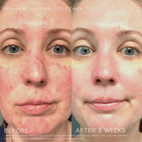 Thumbnail for Rodan and Fields Soothe Regimen for Sensitive, Irritated Skin and Facial Redness