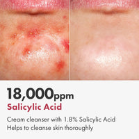 Thumbnail for TOSOWOONG Salicylic Acid Foam Cleanser for Oily Skin, 18,000ppm Salicylic Acid, Deep Pore Cleansing, Face Wash For Breakouts, Exfoliating Cleanser, Korean Skin Care, 100ml, 3.38 fl. oz.