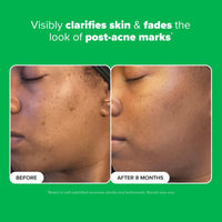 Thumbnail for Paula's Choice BOOST 10% Azelaic Acid Booster Cream Gel, Licorice Extract & Salicylic Acid, Oil-Free Skin Brightening Serum, 1 Ounce