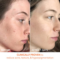 Thumbnail for Dr. Dennis Gross Alpha Beta Universal Daily Peel 60 Treatments