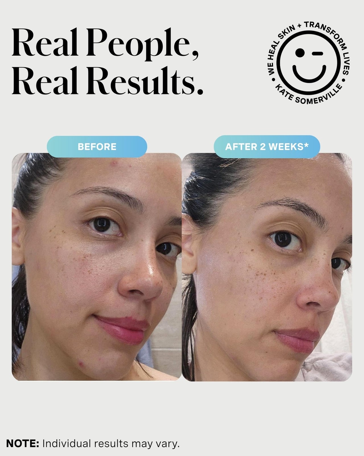 Kate Somerville EradiKate 3% Sulfur Daily Foaming Cleanser Acne Treatment – Clinically Formulated Medicated Face Wash Balances Skin & Cleans Pores, 4 Fl Oz