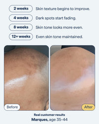 Thumbnail for Remedy Vitamin C Daily Defense and Dark Spots Serum Duo | Even Tone, Brightening & Correcting Set | Ferulic Acid, Tranexamic Acid, Retinol, Kojic Acid | By Dermatologist Dr. Shah | 2 x 1 fl oz