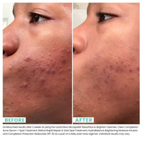 Thumbnail for Clear Complexion Acne Serum + Spot Treatment