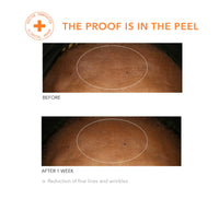 Thumbnail for Dr. Dennis Gross Alpha Beta Universal Daily Peel: for Uneven Tone or Texture and Fine Lines or Enlarged Pores, (5 Treatments)