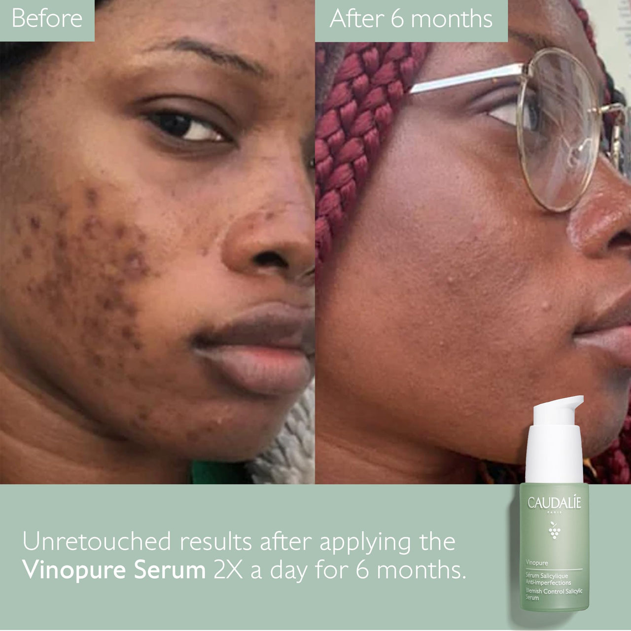 Caudalie Vinopure Natural Salicylic Acid Pore Minimizing Serum with Niacinamide, Skin Perfecting Serum - 30 mL